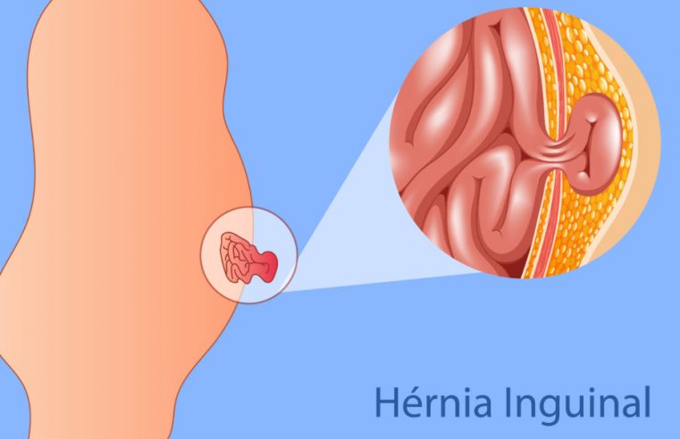 Cirurgião Marcelo Heidrich alerta sobre cuidados em caso de hérnia inguinal