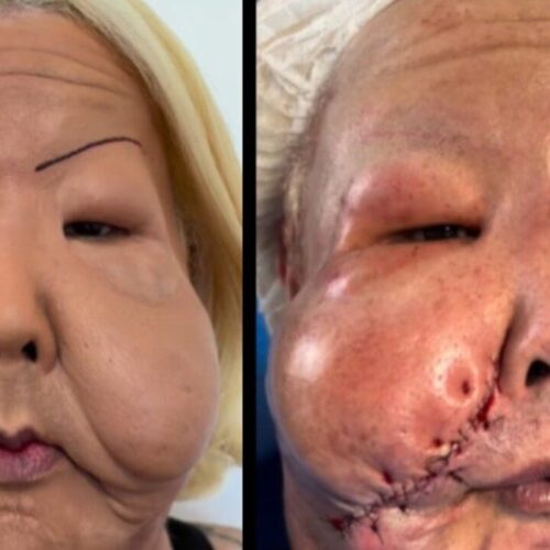 Influenciadora se submete a cirurgia para corrigir deformidade causada por procedimento estético em clínica clandestina