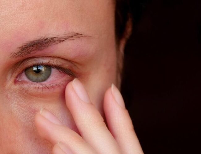 Possível aumento de casos de conjuntivite esperado nas praias durante o final do ano